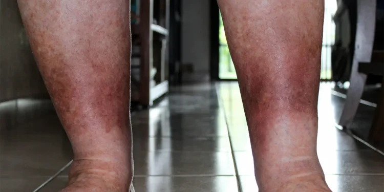 The Emotional Impact of Chronic Vascular Conditions: Can AI Detect Hidden Distress?